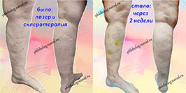 Лазерная коагуляция вен и склеротерапия
