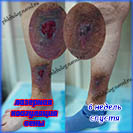 Лазерная коагуляция вен для лечения трофической язвы