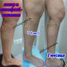 ЭВЛК и минифлебэктомия