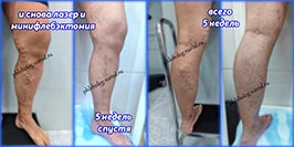 Лазерная коагуляция и минифлебэктомия