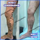 Лазер и склеротерапия