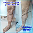 Комбинированная флебэктомия