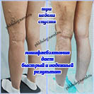 Минифлебэктомия