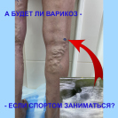Варикоз у спортсменов