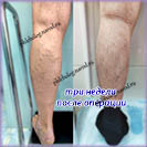 Лазер и минифлебэктомия