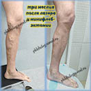 Лазер и минифлебэктомия