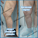 Лазер и минифлебэктомия