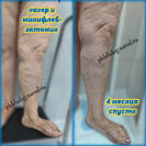 Лазер и минифлебэктомия