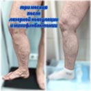Лазер и минифлебэктомия