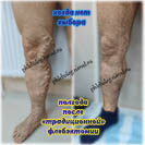 Комбинированная флебэктомия