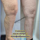 Лазер и минифлебэктомия