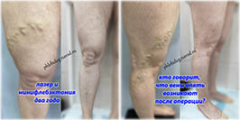 Лазер и минифлебэктомия