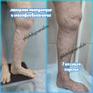 Лазер и минифлебэктомия