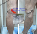 Перфорант Тьери