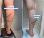 Лазер и минифлебэктомия