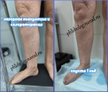 Лазер и склеротерапия