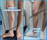 Лазер и минифлебэктомия