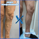 Лазер и минифлебэктомия