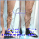 азерная коагуляция большой подкожной вены на бедре и минифлебэктомия