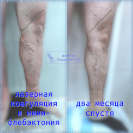 Лазерная коагуляция большой подкожной вены и минифлебэктомия