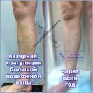 Лазерная коагуляция большой подкожной вены