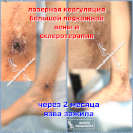 Лазерная коагуляция и склеротерапия в заживлении язв