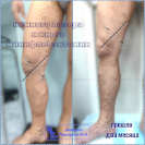 Лазерная коагуляция и минифлебэктомия