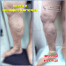 Лазерная коагуляция и минифлебэктомия