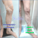 Минифлебэктомия