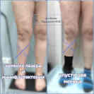 ЭВЛК и минифлебэктомия