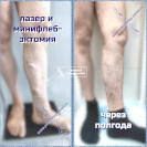Лазер и минифлебэктомия