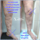 Рецидивный варикоз. Лазер и минифлебэктомия