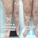 Лазер и минифлебэктомия