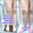 Лазер и минифлебэктомия