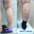 Лазер и минифлебэктомия