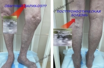 Вторичный варикоз