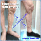 Лазер и минифлебэктомия