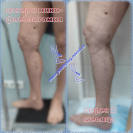 Лазер и минифлебэктомия
