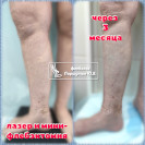 Лазер и минифлебэктомия