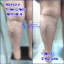 Лазер и минифлебэктомия