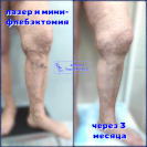 Лазер и минифлебэктомия