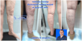 Тотальная ЭВЛК