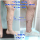 Тотальная ЭВЛК