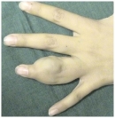 Порок развития вен