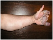 Порок развития вен