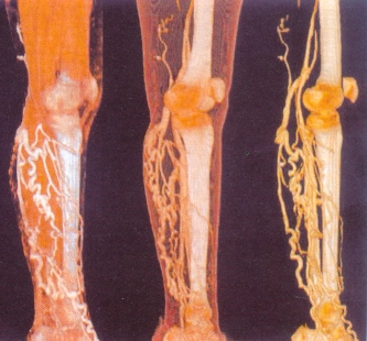спиральная компьютерная томография