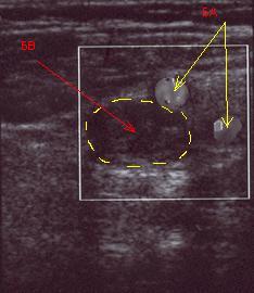 тромбоз глубоких вен