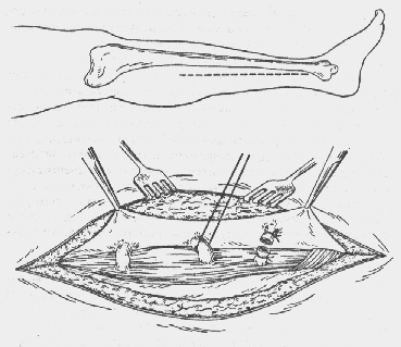 Операция
Линтона
