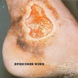 трофическая язва