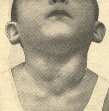 эктазия яремных вен